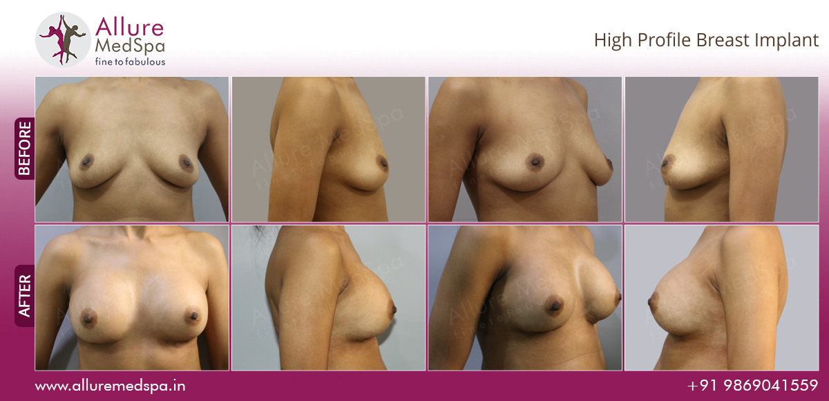 Breast Augmentation Information 30