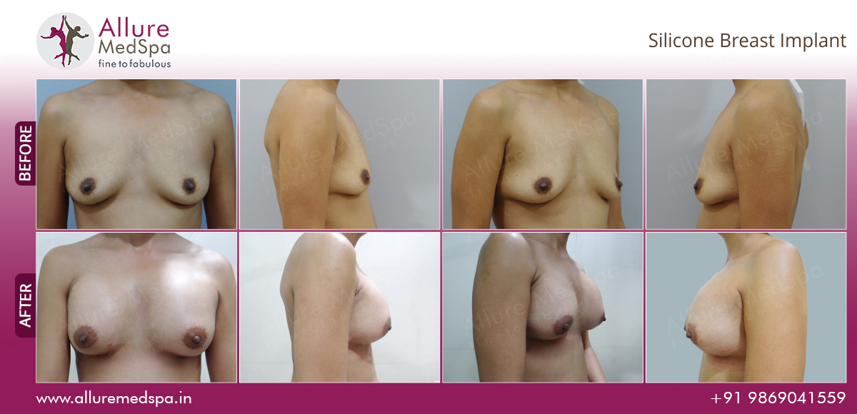 Breast Augmentation Information 19