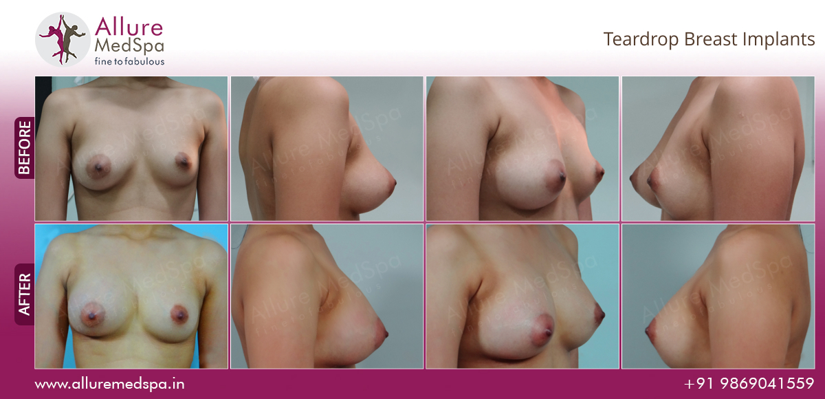 Price Of Breast Implants 14