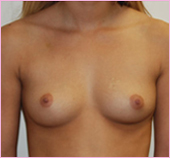 Front View of Breast Implants | Breast Augmentation