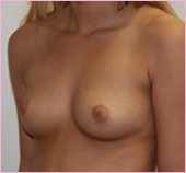 Oblique View of Breast Implants | Breast Augmentation