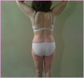 Back View of Liposuction