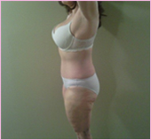 Right View of Liposuction