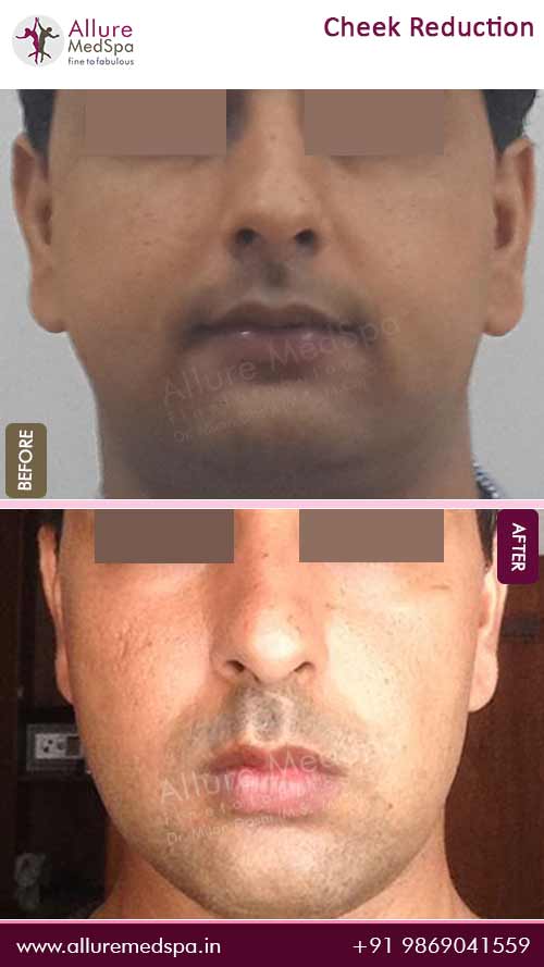 Cheek Fat Reduction Surgery Before and After Images in Mumbai, India