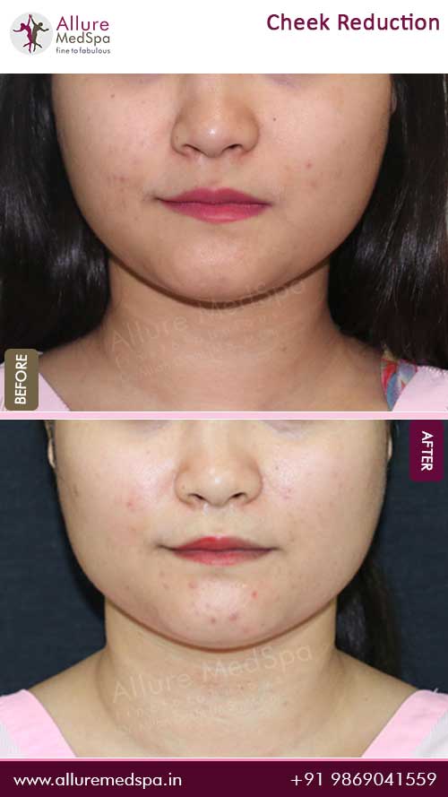 Cheek Reduction Before and After Pictures in Mumbai, India