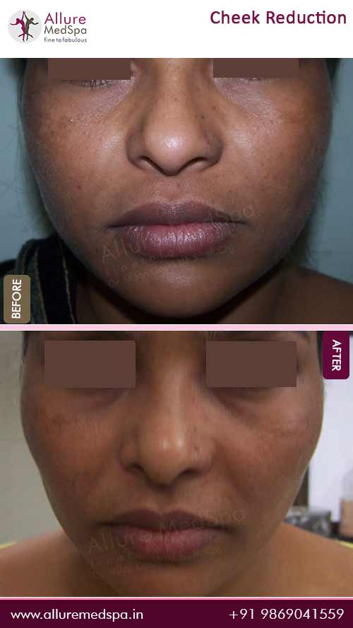 Cheek Reduction Surgery Before and After Results - Mumbai, India