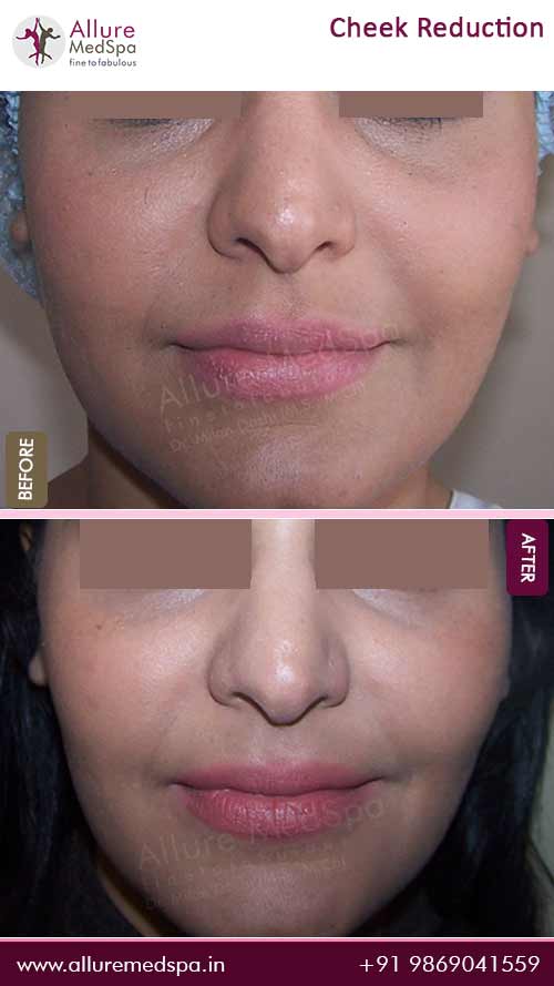 Buccal Fat Removal treatment Before and After Gallery in Mumbai, India