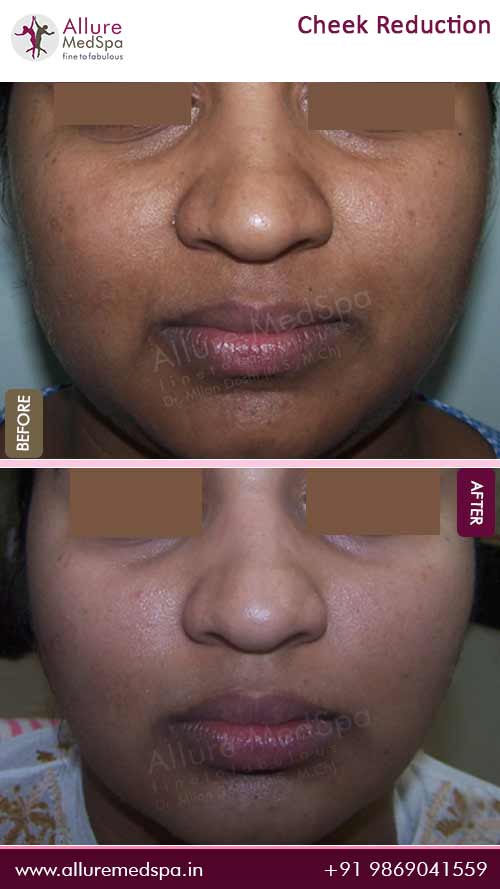 Buccal Fat Removal Before and After Images in Mumbai at allure medspa, cosmetic surgery clinic
