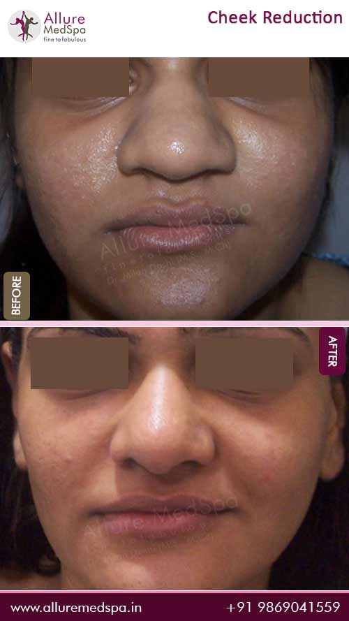Cheek Reduction Surgery Before and After Result at best cosmetic surgery clinic in mumbai