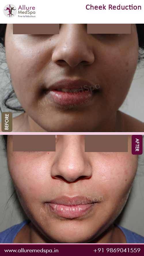 buccal fat removal treatment before and after pictures in mumbai, india by dr milan doshi
