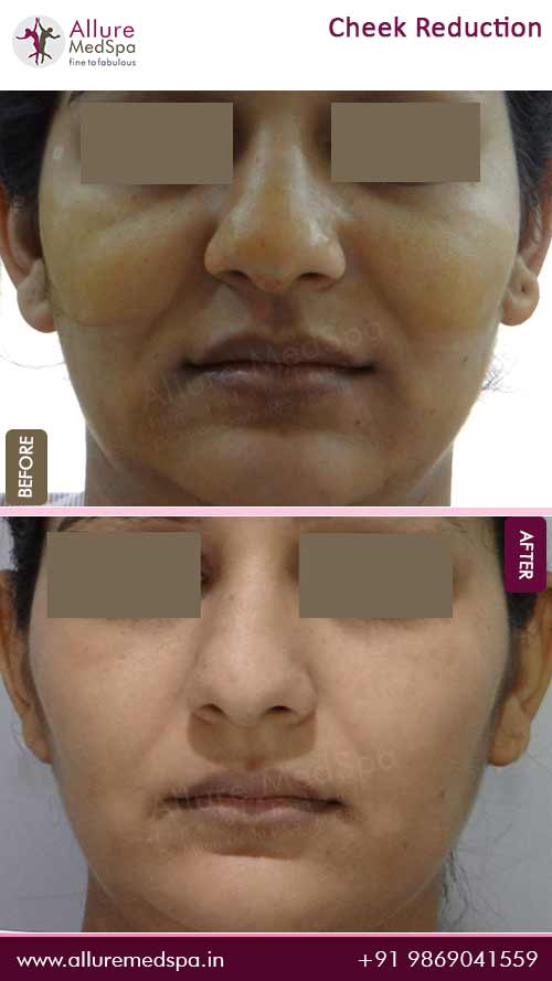 Buccal Fat Removal before and after result of best cosmetic surgery clinic in mumbai