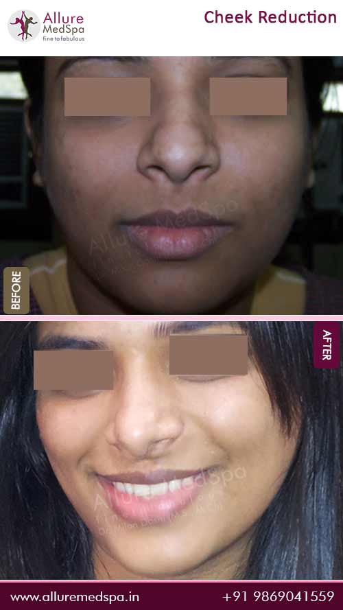 before and after results of cheek reduction surgery at allure medspa, Mumbai, India