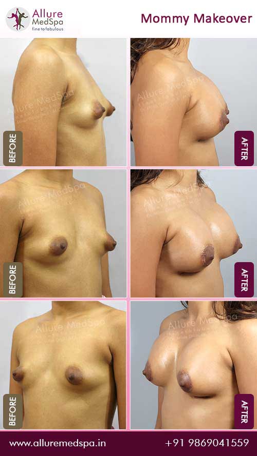 Breast augmentation surgery before and after image in mumbai