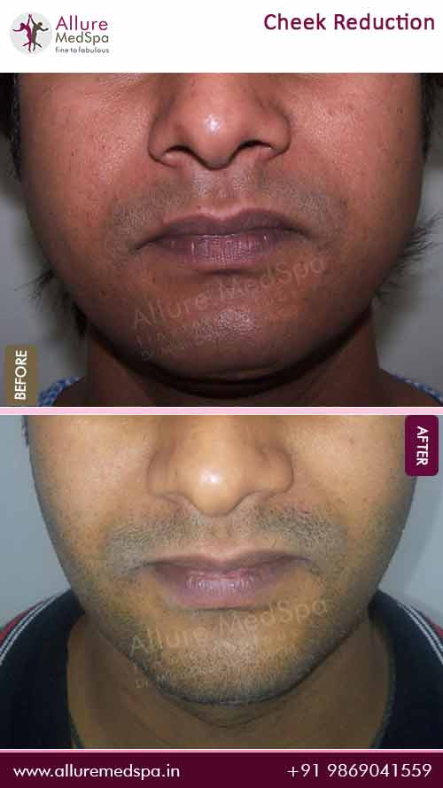 Before and After Image of Cheek Fat Reduction Surgery in Mumbai, India