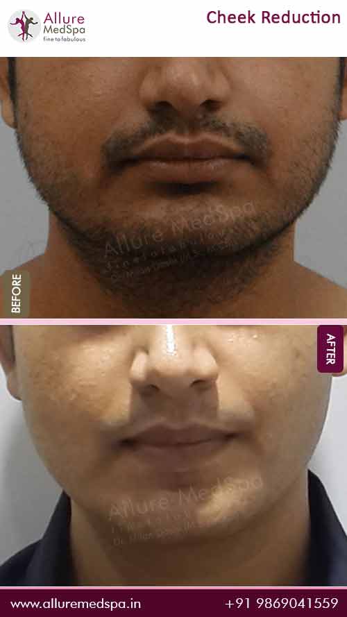 Buccal Fat Removal Treatment Before and After Pictures in Mumbai, India