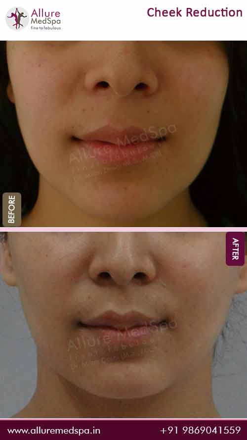 Buccal Fat Removal Treatment Before and After result at Allure MedSpa, Best Cosmetic Surgery in Andheri, Mumbai