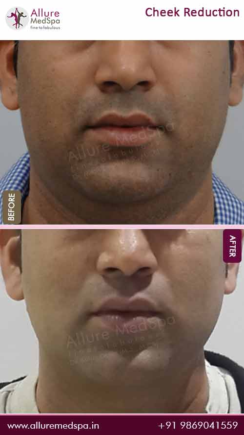 cheek reduction surgery before and after image by the best cosmetic surgeon in Mumbai, Dr Milan Doshi