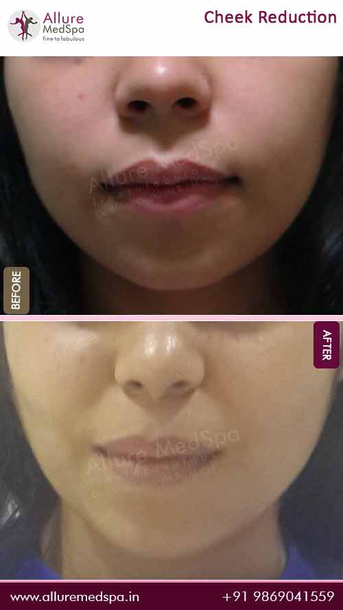 Buccal Fat Removal Surgery Before and After Gallery in Mumbai, India
