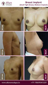 Breast augmentation surgery before and after photos at Cosmetic surgery clinic in Mumbai