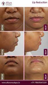 Impressive results visible in these before and after photos of lip reduction surgery in mumbai
