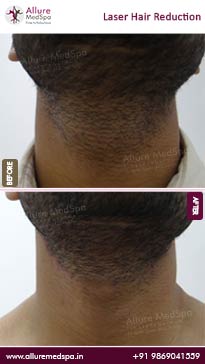 Permanent Laser Hair Removal cost at Andheri West, Mumbai