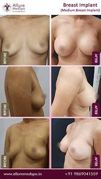 Breast augmentation surgery before and after picture result, great transformation