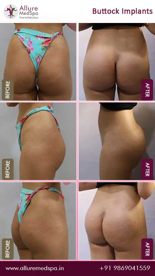 Noticeable difference in the size and shape of the buttocks before and after buttock implants surgery in mumbai