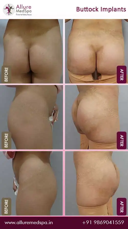 Before and after photos of successful buttock augmentation surgery by best cosmetic surgeon in Mumbai