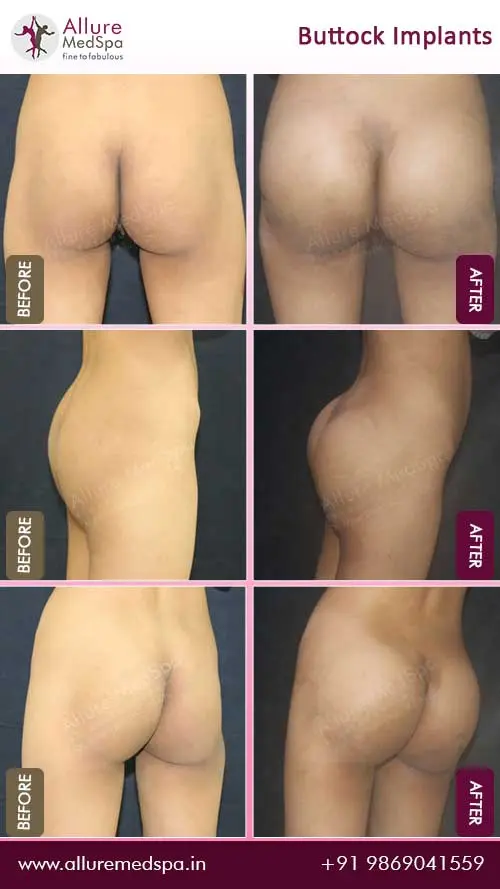 Before and after photos of buttock augmentation surgery demonstrating the significant enhancement of the buttock area in mumbai