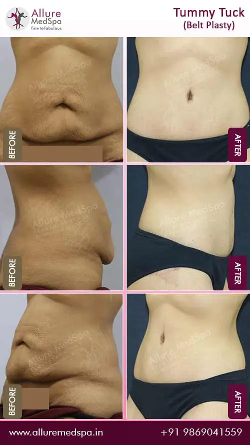 Abdominoplasty Surgery Before and After Photos in Mumbai, India