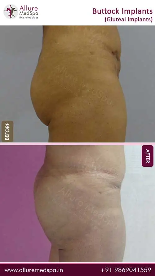 Photos before and after buttock implant surgery illustrating the natural-looking and aesthetically pleasing results at allure medspa