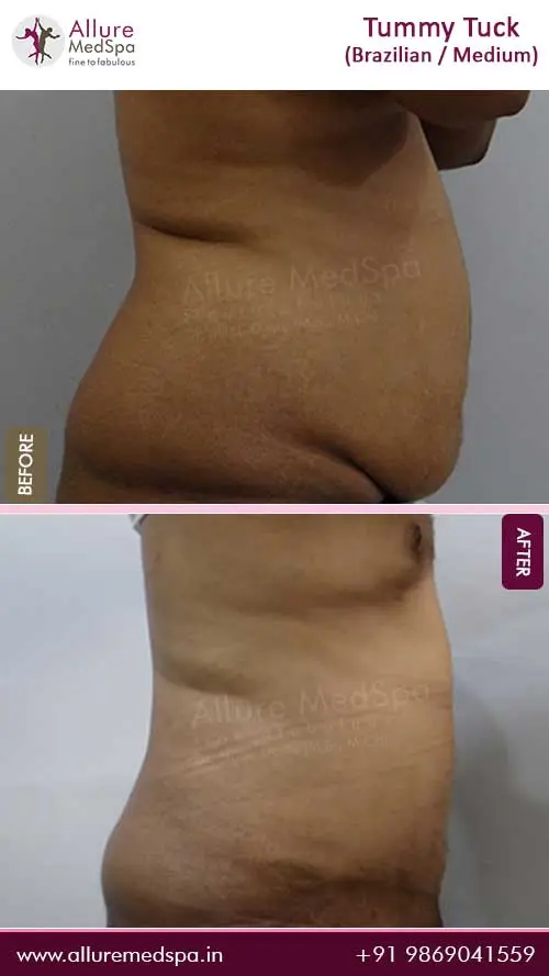 male brazilian tummy tuck surgery before and after Images by best surgeon in Mumbai