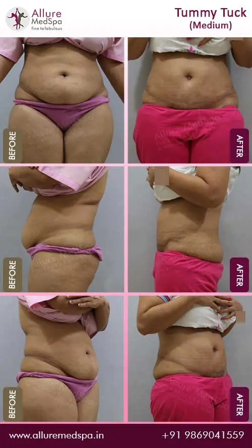 Tummy Tuck Surgery Before and After Pictures in Mumbai, India