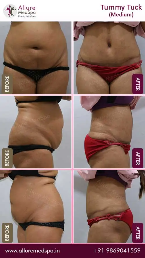 Abdominoplasty Before and After Gallery in Mumbai, India