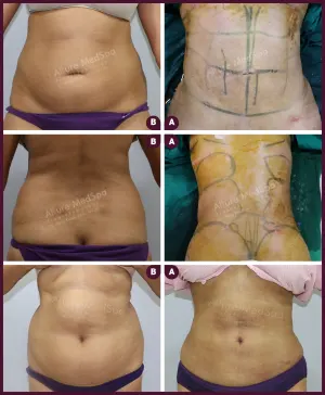 female large abdomen liposuction surgery Mumbai city hospitals and clinics