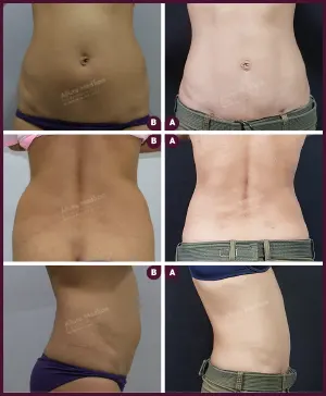 female small abdomen liposuction Surgery Cost In mumbai at Best Cost