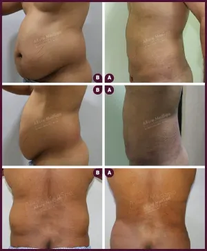 male large abdomen liposuction surgery in mumbai at Allure Medspa