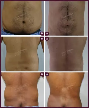 male large abdomen liposuction surgery in Mumbai