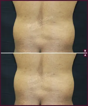 male medium abdomen male small abdomen liposuction surgery in Mumbai by Best docter