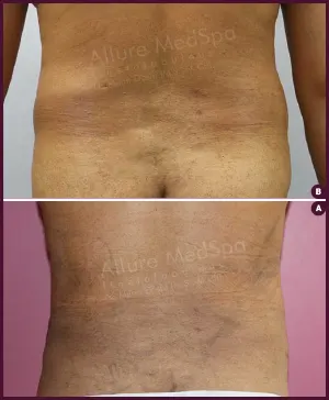 male medium abdomen liposuction surgery Liposuction in Mumbai city hospitals and clinics