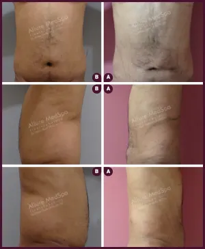 male medium abdomen liposuction surgery in Mumbai At best cost