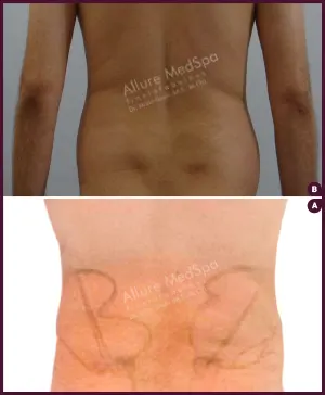 male medium abdomen liposuction surgery in India