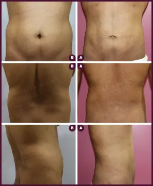 male medium abdomen liposuction surgery best doctor.