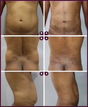 male small abdomen liposuction surgery in Mumbai by Best docter