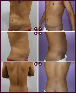 male small abdomen liposuction surgery in Mumbai by Best docter