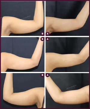 medium arm female liposuction surgery in mumbai By Dr.Milan Doshi