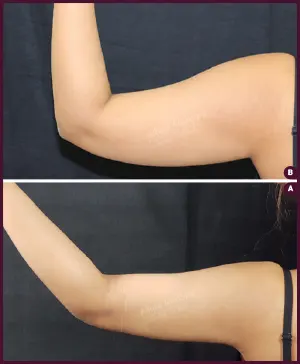 medium arm female liposuction surgery at Best Cost by Dr. Milan Doshi