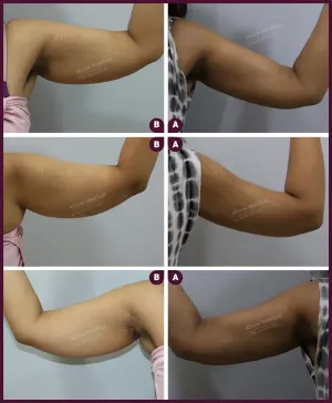 thin arm female liposuction double chin male liposuction surgery from alure Medspa In mumbai at Best Cost