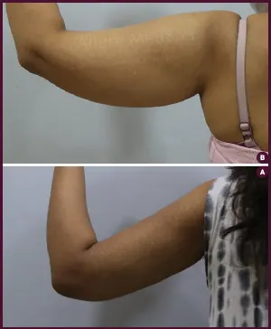 thin arm female liposuction surgery at Best Cost by Dr. Milan Doshi in Mumbai