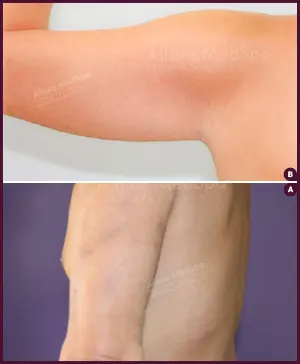Male arm liposuction surgery By Best docter By Best docter In mumbai at Best Cost